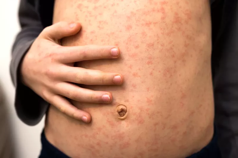 Image: measles on skin