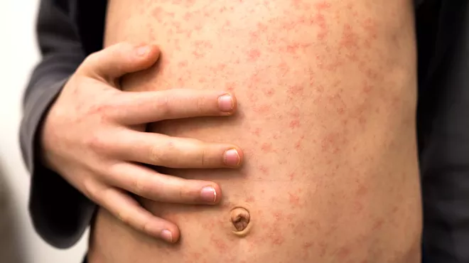 measles on skin