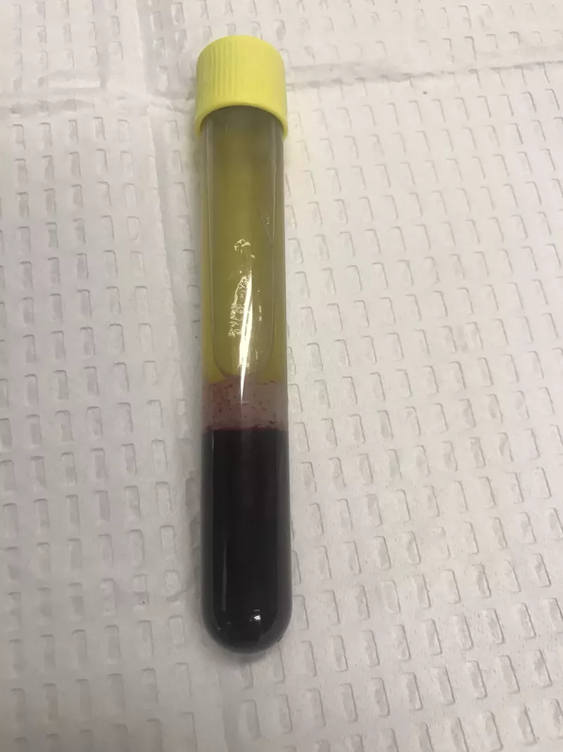 Image: This is what your blood looks like after it has been spun. The platelet rich plasma used for the facial has separated at the top.