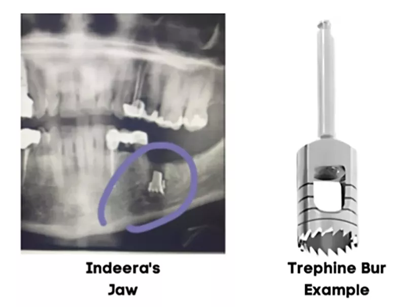 Image: This is the kind of drill bit used in Indeera Musa's dental surgery last year. A piece of it was allegedly left in her jaw causing pain in the months after the surgery.