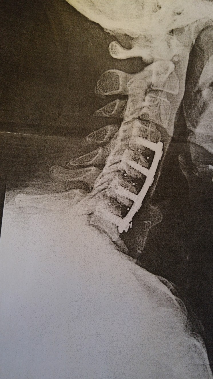 Garrett's X-ray after his first surgery, which he says the surgeon botched. - COURTESY SCOTT GARRETT