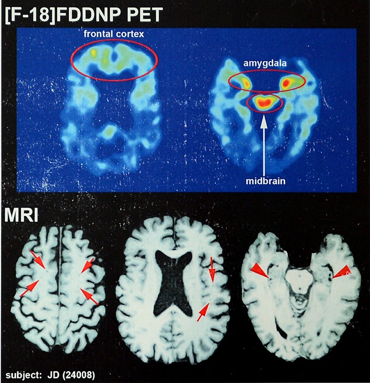 Recent brain scans of NFL hall of famer Joe DeLamielleure, who was diagnosed with CTE, the brain injury that is affecting many former football players. - JEFF SINER/TNS/NEWSCOM