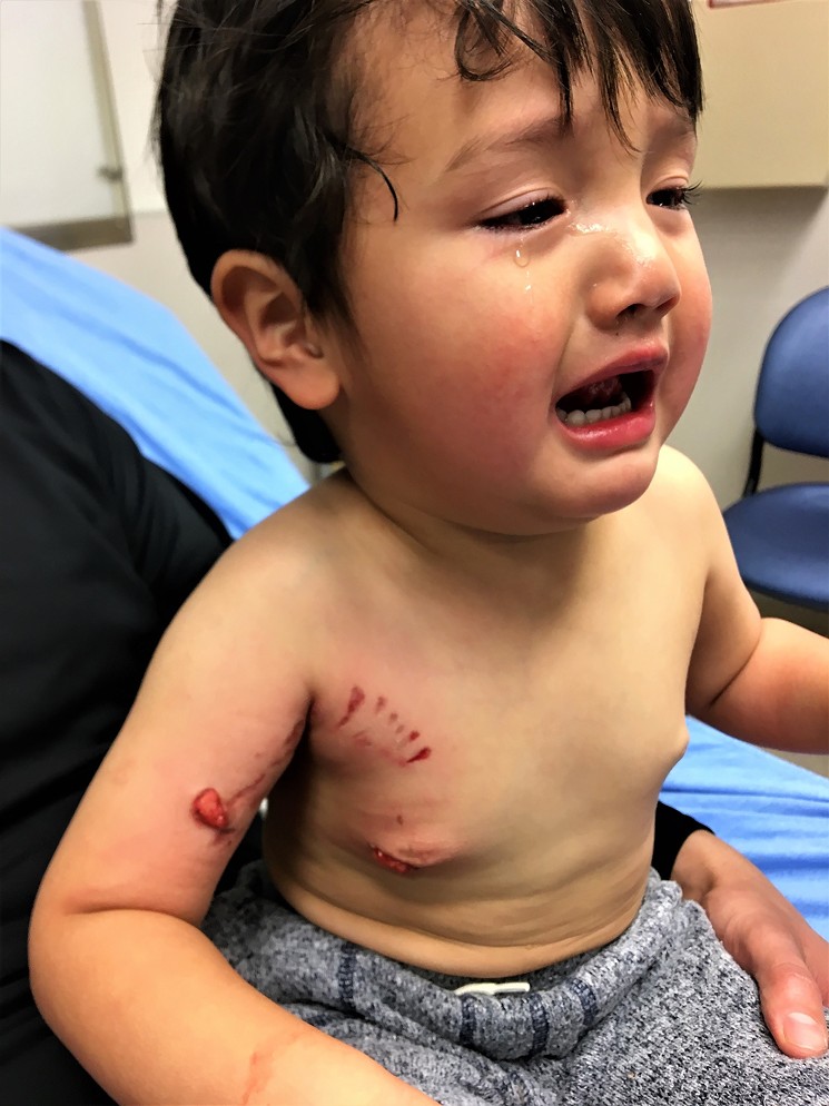 Luca Romero was attacked by a pit bull at a dog adoption event in Klyde Warren Park last year. - ALAN ROMERO