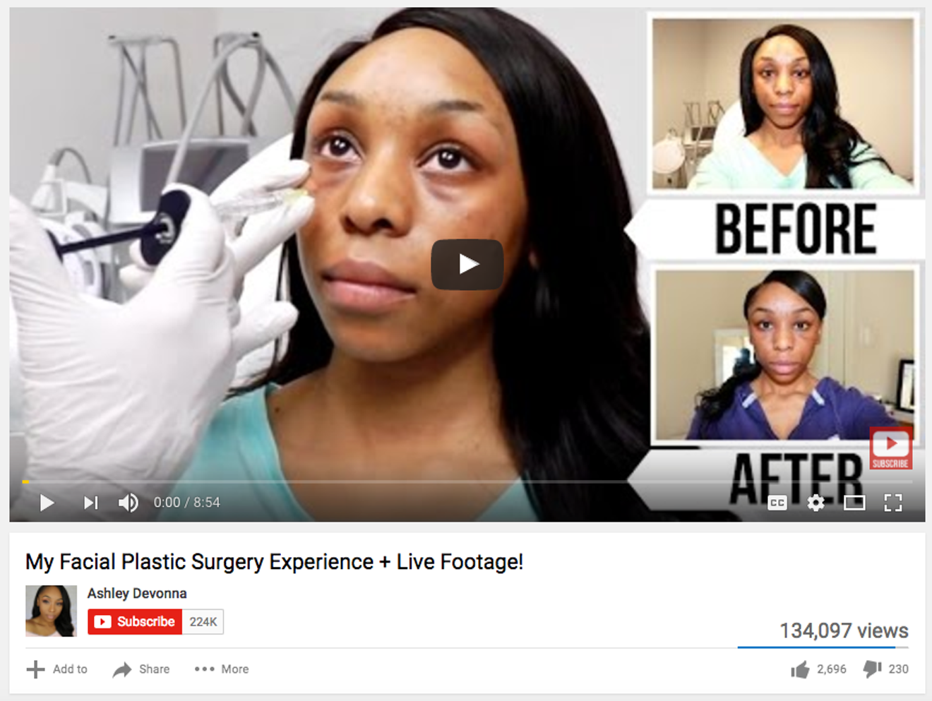 Ashley Devonna vlogged her under-eye filler procedure in March. She will do the same Friday for her breast augmentation.